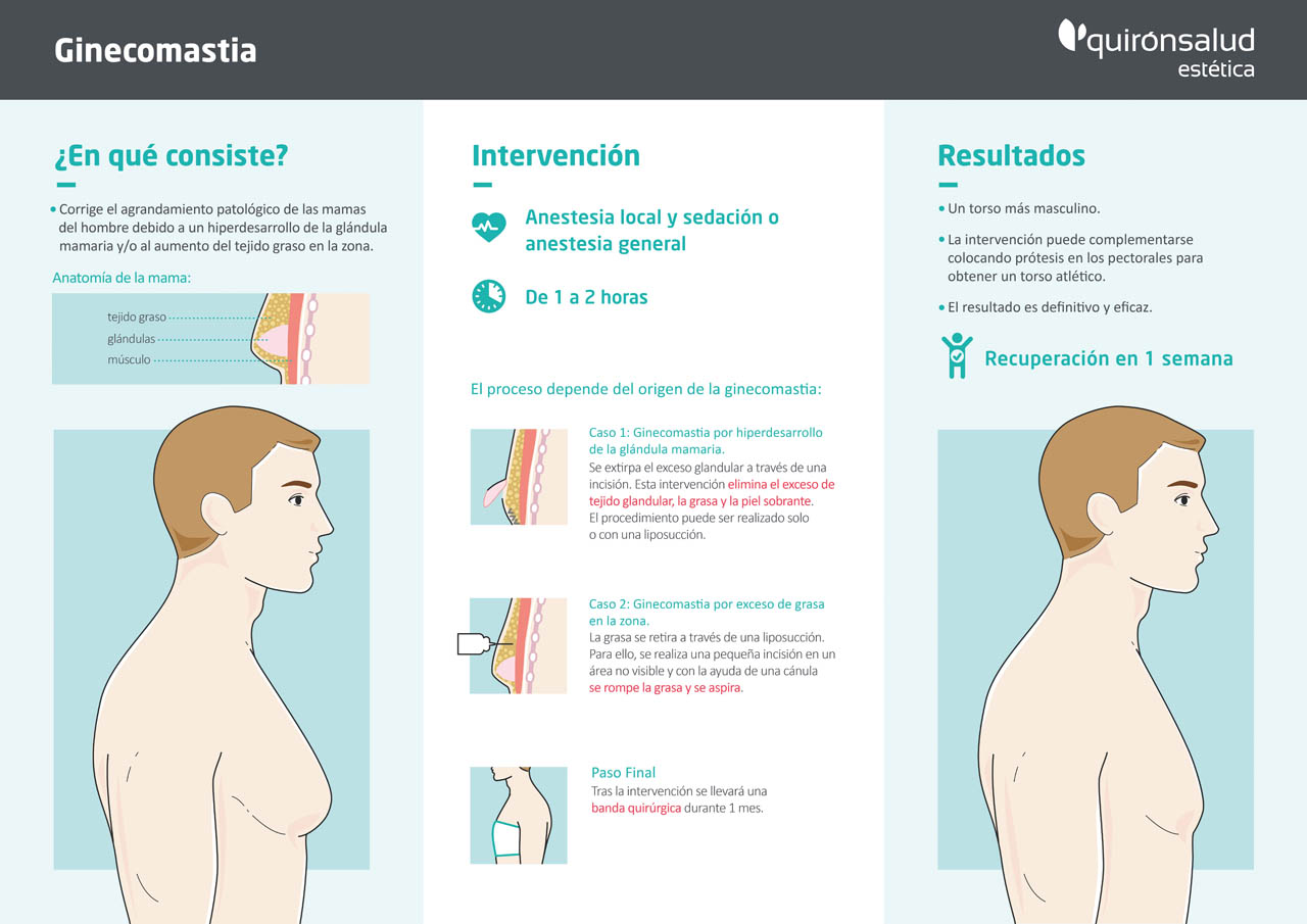 Infografía Ginecomastia